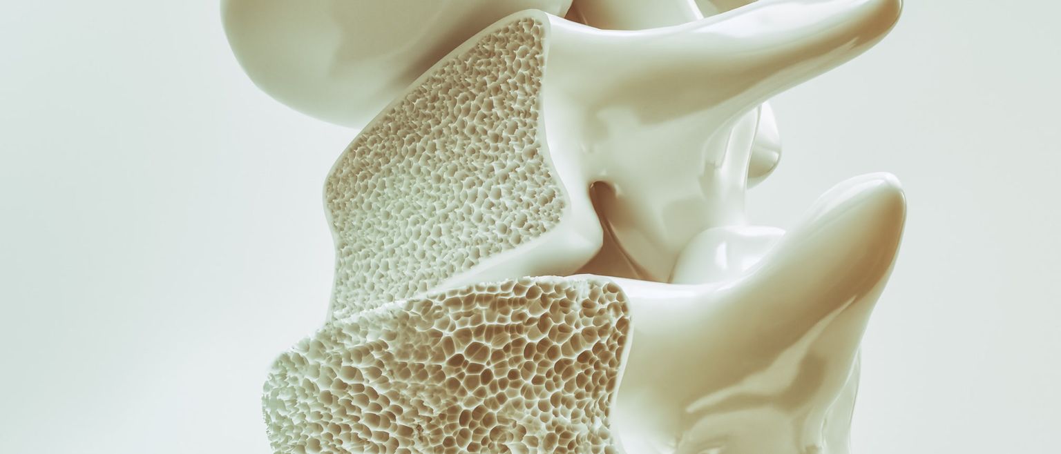 A close-up medical illustration of two vertebral bones in a spine with the top bone appearing healthy, but the bottom bone showing significant bone density loss due to osteoporosis.