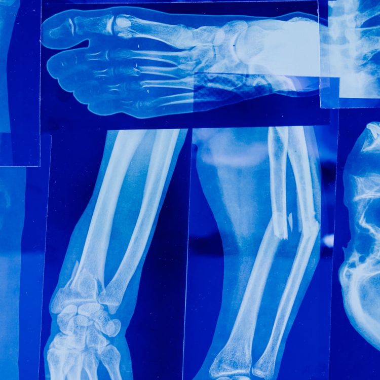 Several blue-toned X-rays showing a human foot and a broken forearm.