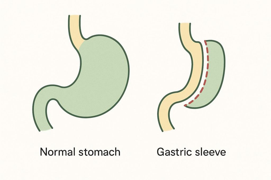 A simple diagram depicting the difference between a normal stomach and a stomach after gastric sleeve surgery, highlighting how the stomach size is reduced.