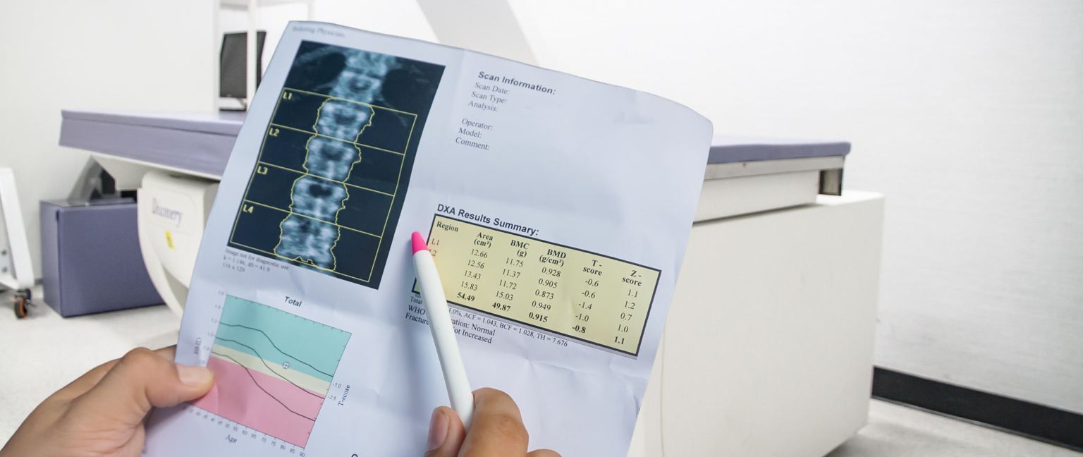 A patient holds a printed report of their DEXA scan results, showing a bone density summary and an image of the patient's spine, with a DEXA machine in the background.